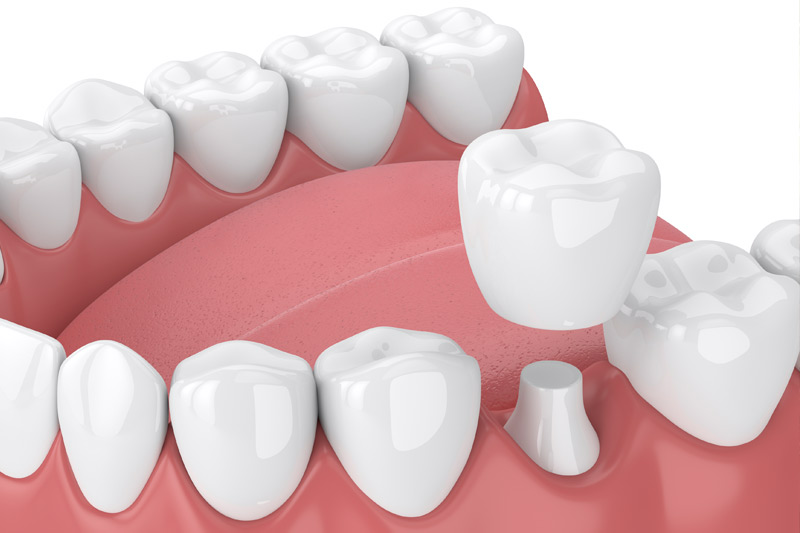 Dental Crowns in Brentwood