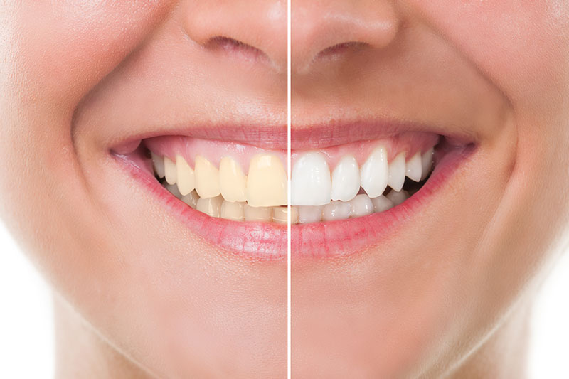 Teeth Whitening in Brentwood