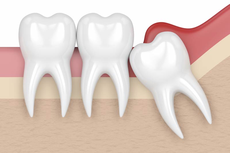 Wisdom Tooth Removal in Brentwood